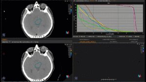 Animation: plan comparison adenoma of parotid gland