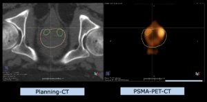 Example indication pelvis: Prostate cancer