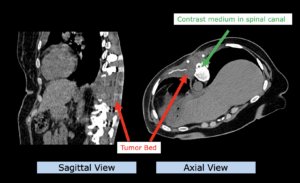 Example: sarcoma