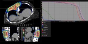 Treatment plan sarcoma
