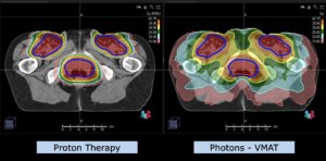 Example Indication Pelvis: Vaginal Cancer Plan Comparison