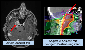 Beispiel HNO: Nasopharynx-Karzinom