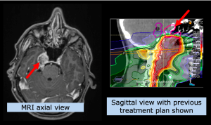 Example Head and Neck: Nasopharynx Carcinoma